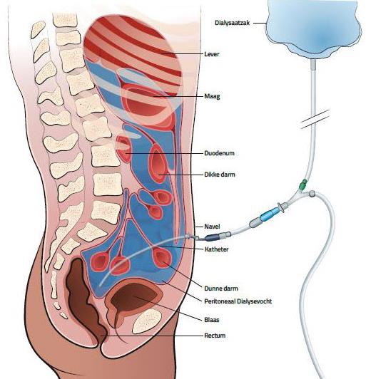 Deze afbeelding geeft weer hoe de spoelvloeistof uit een dialysaatzak via een katheter in de buikholte loopt (bron: Baxter).